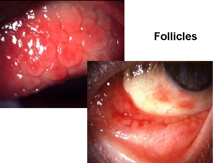 Follicles 8 