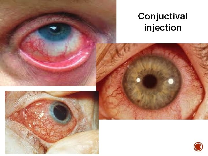 Conjuctival injection 9 