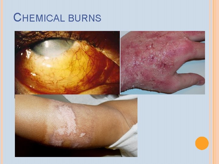 CHEMICAL BURNS 