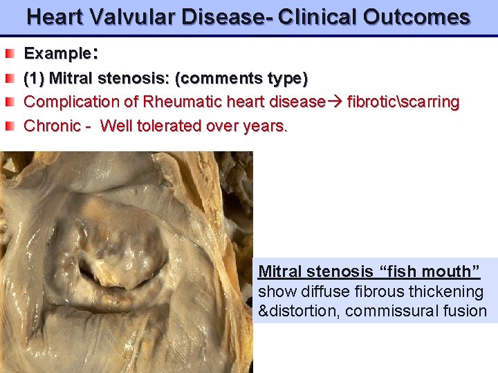Heart Valvular Disease- Clinical Outcomes Example: (1) Mitral stenosis: (comments type) Complication of Rheumatic