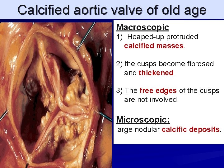 Calcified aortic valve of old age Macroscopic 1) Heaped-up protruded calcified masses. 2) the