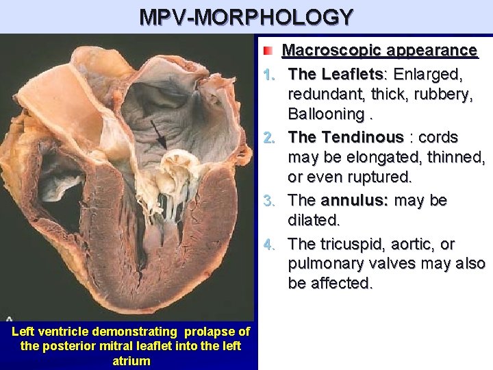 MPV-MORPHOLOGY 1. 2. 3. 4. Left ventricle demonstrating prolapse of the posterior mitral leaflet
