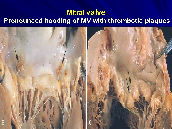 Mitral valve Pronounced hooding of MV with thrombotic plaques 