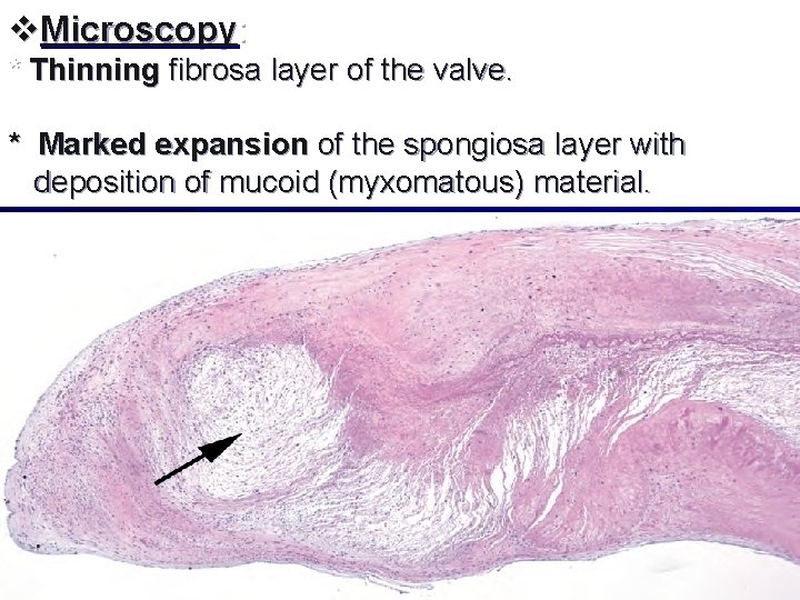 v. Microscopy: * Thinning fibrosa layer of the valve. * Marked expansion of the