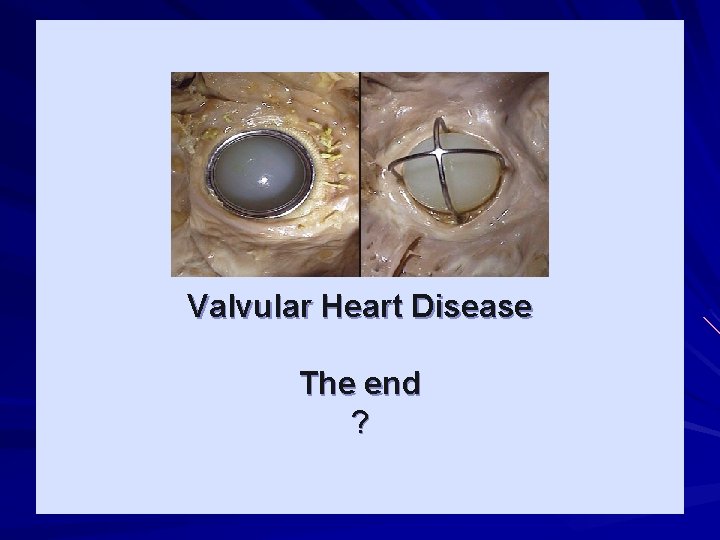 Valvular Heart Disease The end ? 