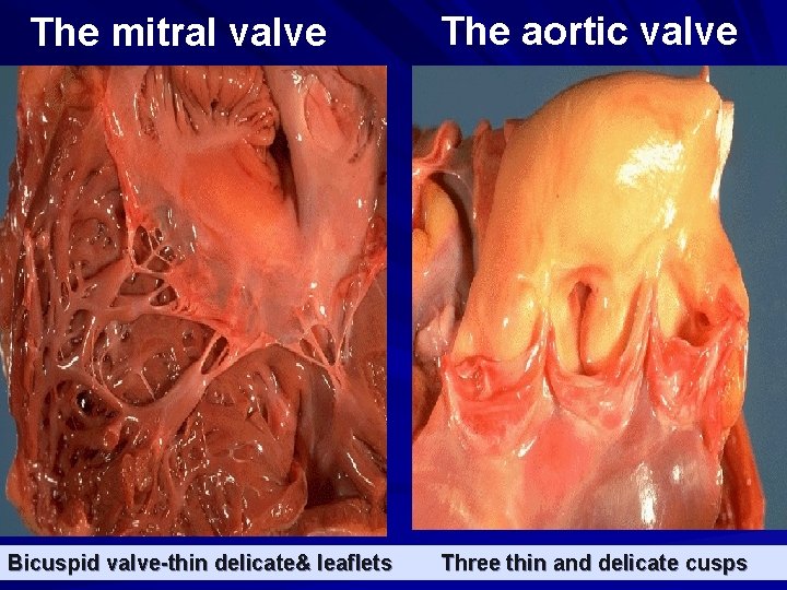 The mitral valve Bicuspid valve-thin delicate& leaflets The aortic valve Three thin and delicate