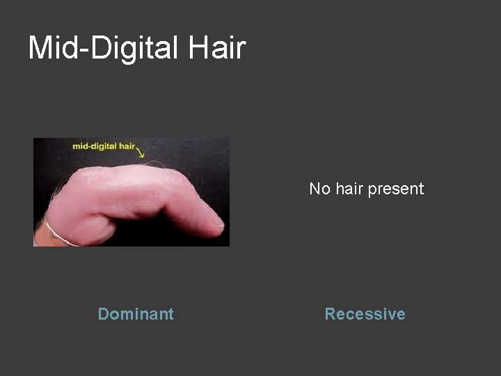 Mid-Digital Hair No hair present Dominant Recessive 