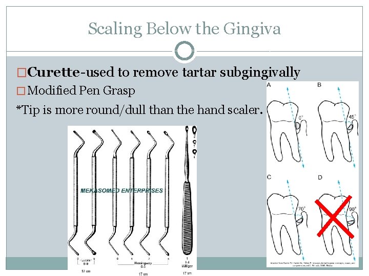 Scaling Below the Gingiva �Curette-used to remove tartar subgingivally � Modified Pen Grasp *Tip