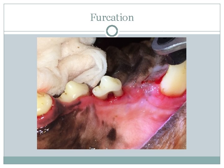 Furcation 