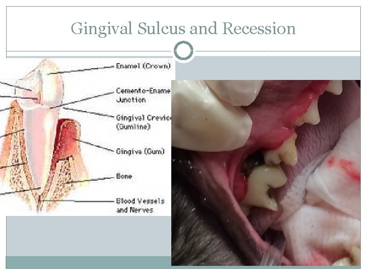 Gingival Sulcus and Recession 