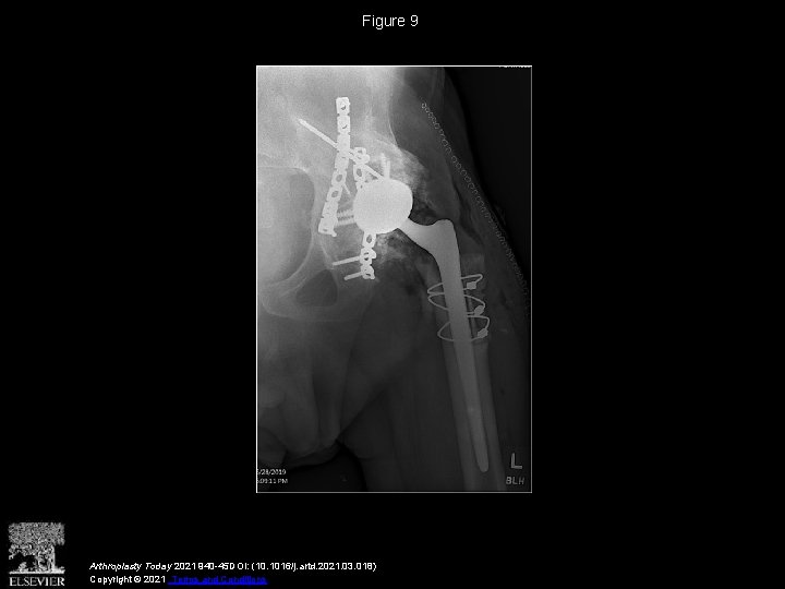 Figure 9 Arthroplasty Today 2021 940 -45 DOI: (10. 1016/j. artd. 2021. 03. 018)