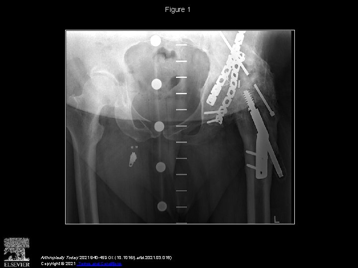 Figure 1 Arthroplasty Today 2021 940 -45 DOI: (10. 1016/j. artd. 2021. 03. 018)
