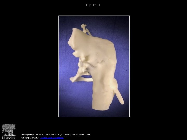 Figure 3 Arthroplasty Today 2021 940 -45 DOI: (10. 1016/j. artd. 2021. 03. 018)