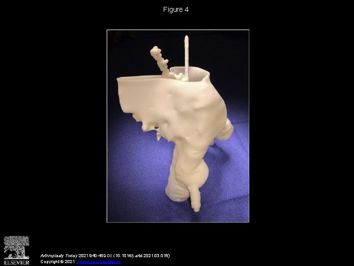 Figure 4 Arthroplasty Today 2021 940 -45 DOI: (10. 1016/j. artd. 2021. 03. 018)