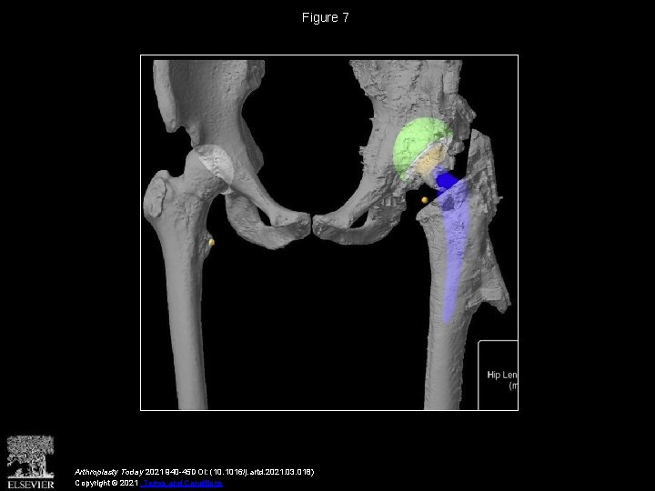 Figure 7 Arthroplasty Today 2021 940 -45 DOI: (10. 1016/j. artd. 2021. 03. 018)