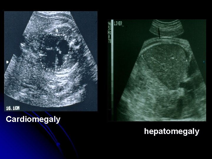 Cardiomegaly hepatomegaly 