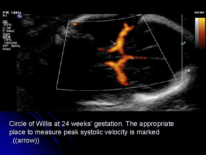Circle of Willis at 24 weeks’ gestation. The appropriate place to measure peak systolic