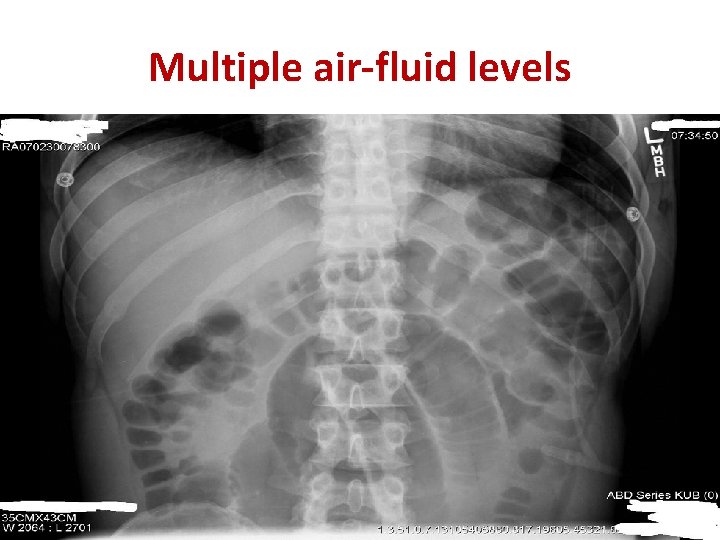 Multiple air-fluid levels 