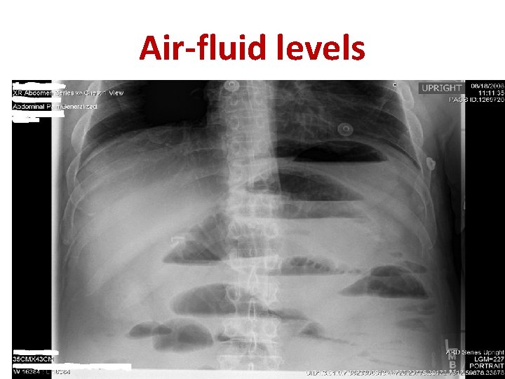 Air-fluid levels 