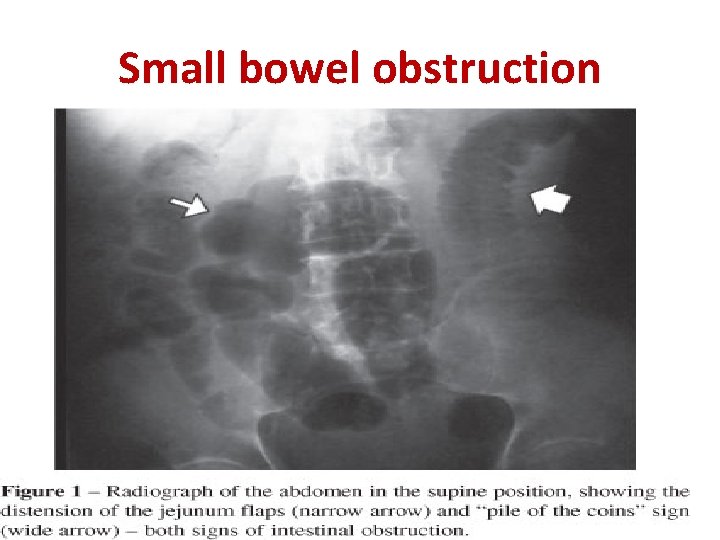 Small bowel obstruction 