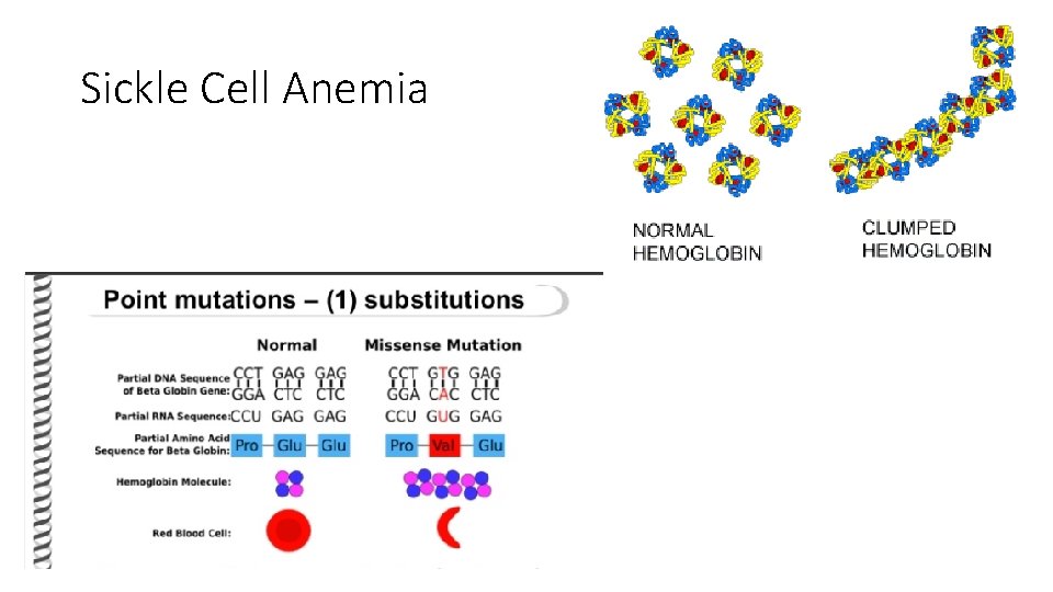 Sickle Cell Anemia 