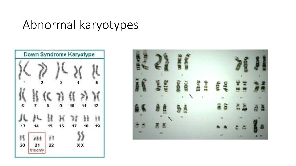 Abnormal karyotypes 