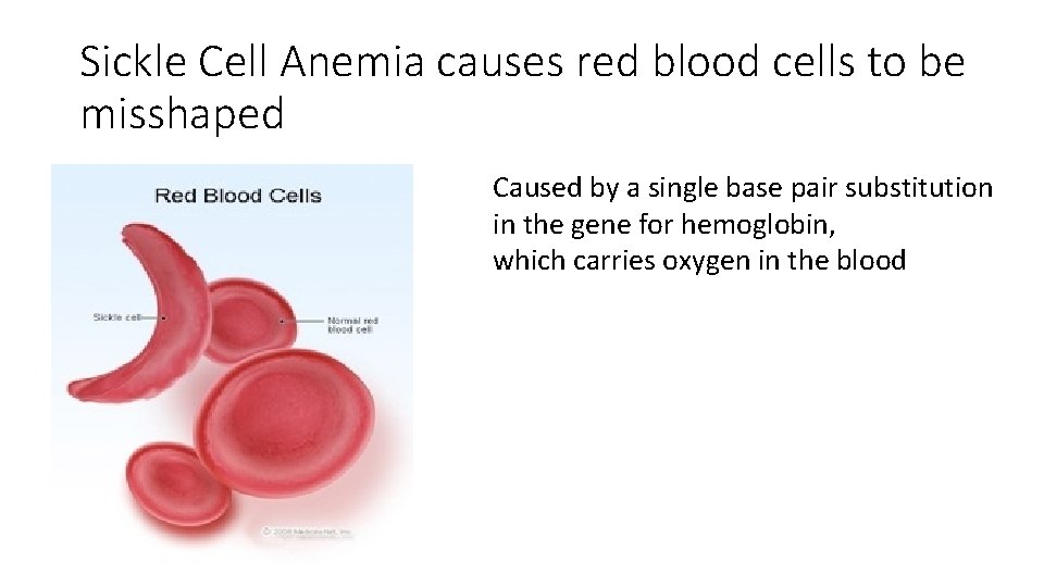 Sickle Cell Anemia causes red blood cells to be misshaped Caused by a single