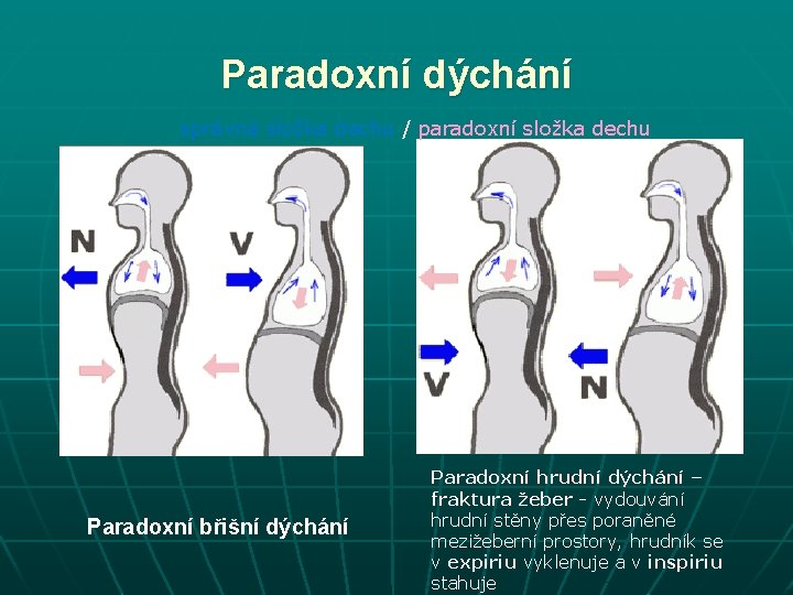 Paradoxní dýchání správná složka dechu / paradoxní složka dechu Paradoxní břišní dýchání Paradoxní hrudní