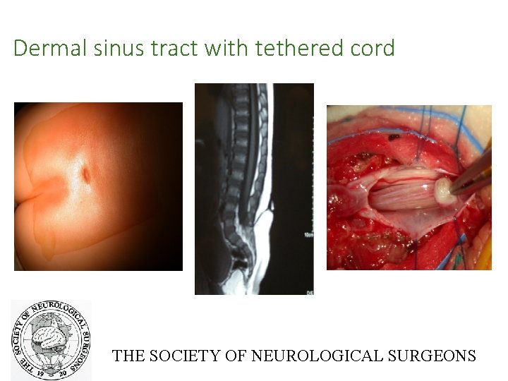 Dermal sinus tract with tethered cord THE SOCIETY OF NEUROLOGICAL SURGEONS 