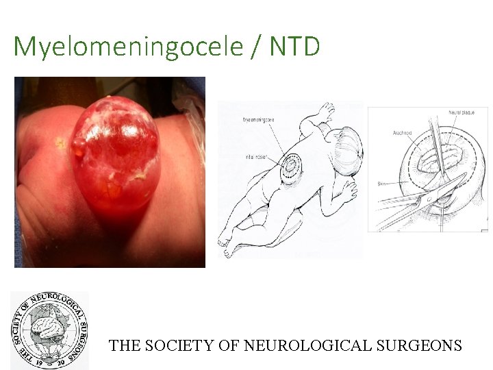 Myelomeningocele / NTD THE SOCIETY OF NEUROLOGICAL SURGEONS 