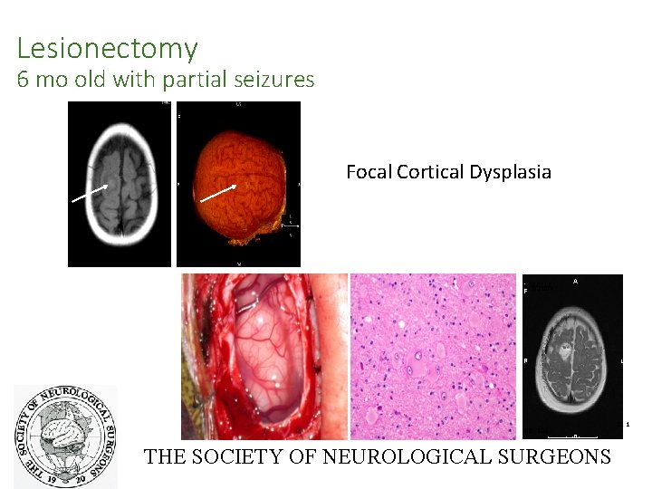 Lesionectomy 6 mo old with partial seizures 7788111 1/9/2004 F Focal Cortical Dysplasia Page: