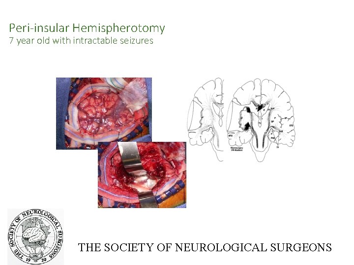 Peri-insular Hemispherotomy 7 year old with intractable seizures THE SOCIETY OF NEUROLOGICAL SURGEONS 