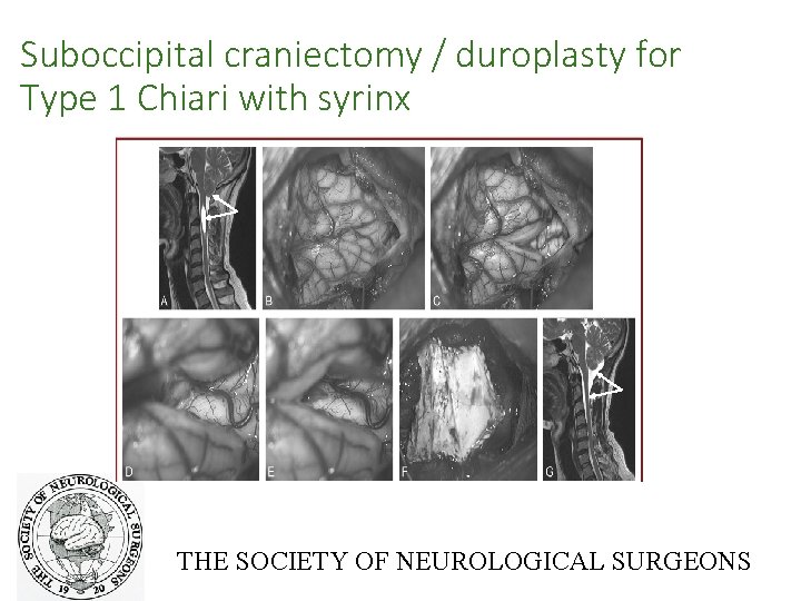 Suboccipital craniectomy / duroplasty for Type 1 Chiari with syrinx THE SOCIETY OF NEUROLOGICAL