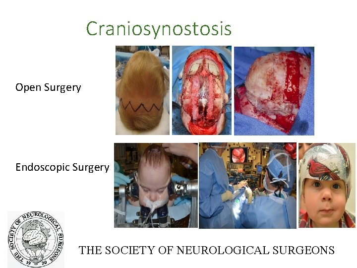 Craniosynostosis Open Surgery Endoscopic Surgery THE SOCIETY OF NEUROLOGICAL SURGEONS 