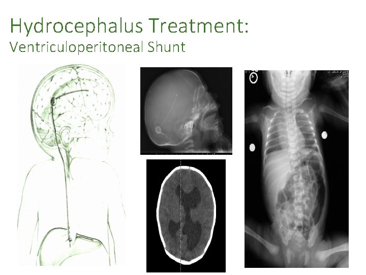 Hydrocephalus Treatment: Ventriculoperitoneal Shunt THE SOCIETY OF NEUROLOGICAL SURGEONS 