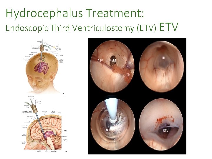 Hydrocephalus Treatment: Endoscopic Third Ventriculostomy (ETV) ETV THE SOCIETY OF NEUROLOGICAL SURGEONS 