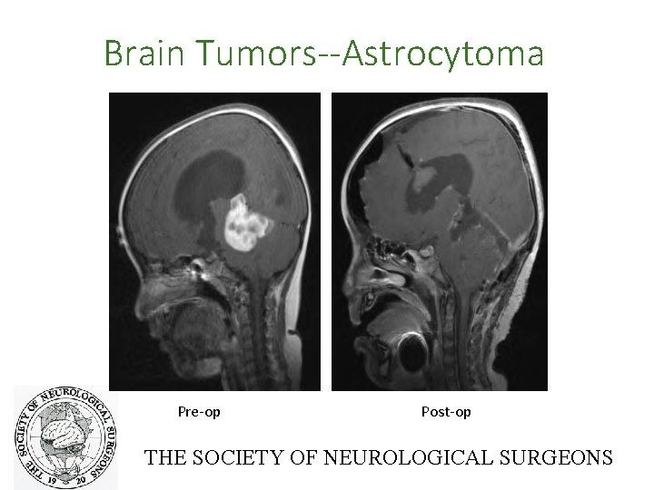 Brain Tumors--Astrocytoma Pre-op Post-op THE SOCIETY OF NEUROLOGICAL SURGEONS 