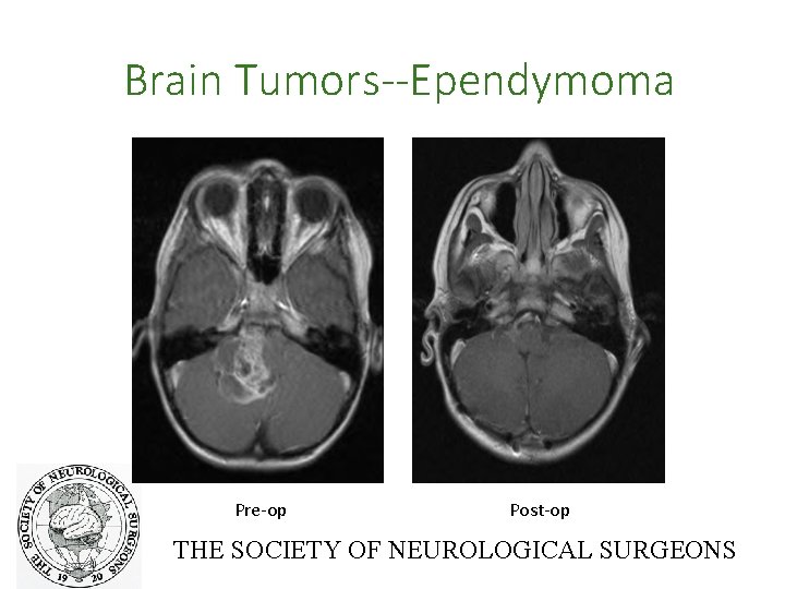 Brain Tumors--Ependymoma Pre-op Post-op THE SOCIETY OF NEUROLOGICAL SURGEONS 