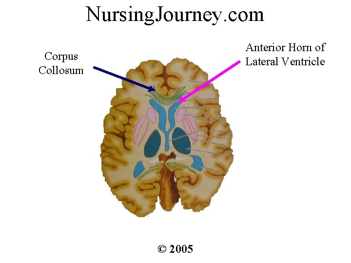 Nursing. Journey. com Anterior Horn of Lateral Ventricle Corpus Collosum © 2005 