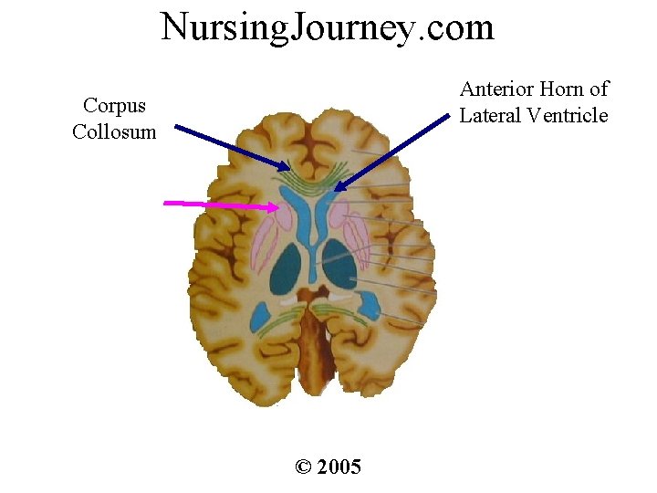 Nursing. Journey. com Anterior Horn of Lateral Ventricle Corpus Collosum © 2005 