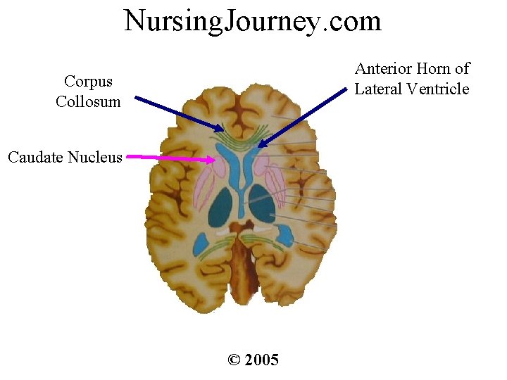 Nursing. Journey. com Anterior Horn of Lateral Ventricle Corpus Collosum Caudate Nucleus © 2005