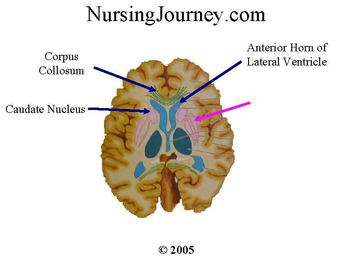Nursing. Journey. com Anterior Horn of Lateral Ventricle Corpus Collosum Caudate Nucleus © 2005