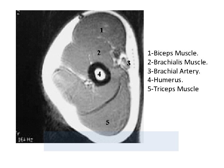 1 -Biceps Muscle. 2 -Brachialis Muscle. 3 -Brachial Artery. 4 -Humerus. 5 -Triceps Muscle