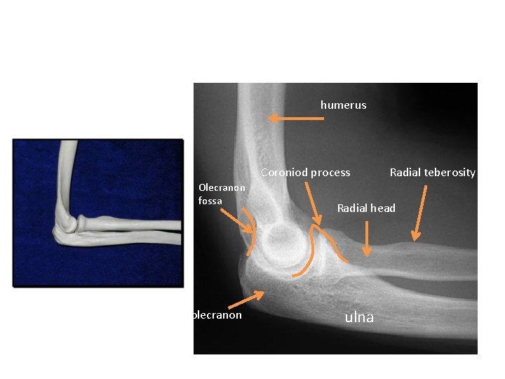 humerus Coroniod process Olecranon fossa olecranon Radial teberosity Radial head ulna 