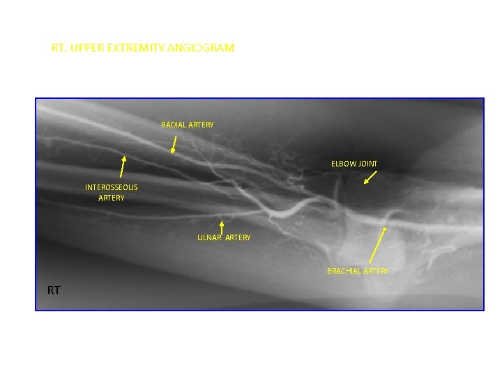 RT. UPPER EXTREMITY ANGIOGRAM RADIAL ARTERY ELBOW JOINT INTEROSSEOUS ARTERY ULNAR ARTERY BRACHIAL ARTERY