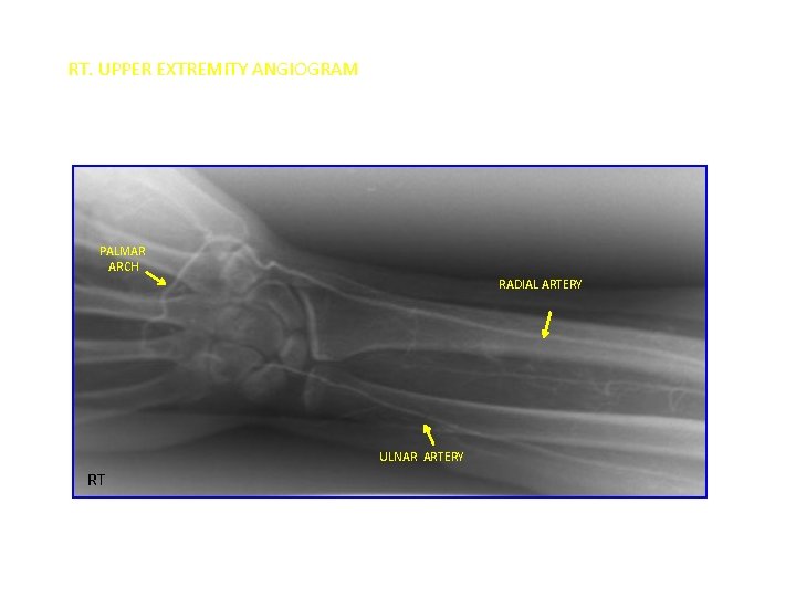 RT. UPPER EXTREMITY ANGIOGRAM PALMAR ARCH RADIAL ARTERY ULNAR ARTERY RT 