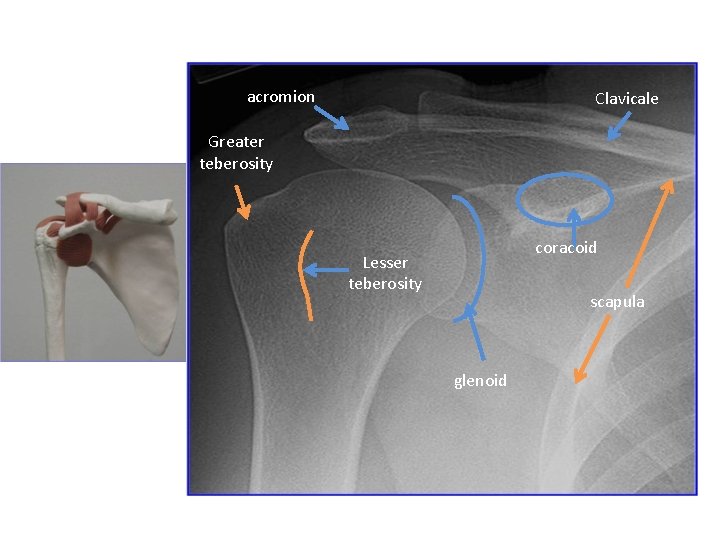 acromion Clavicale Greater teberosity coracoid Lesser teberosity scapula glenoid 