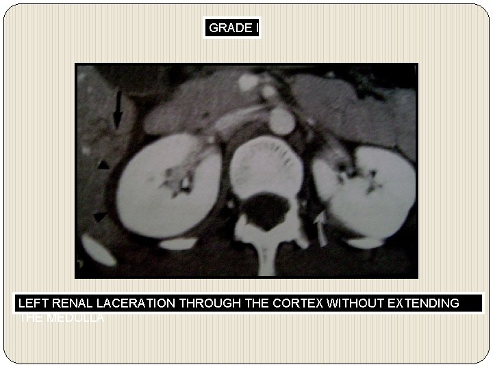 GRADE II LEFT RENAL LACERATION THROUGH THE CORTEX WITHOUT EXTENDING THE MEDULLA 