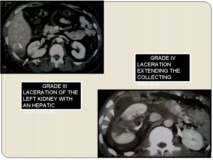GRADE III LACERATION OF THE LEFT KIDNEY WITH AN HEPATIC CONTUSION GRADE IV LACERATION