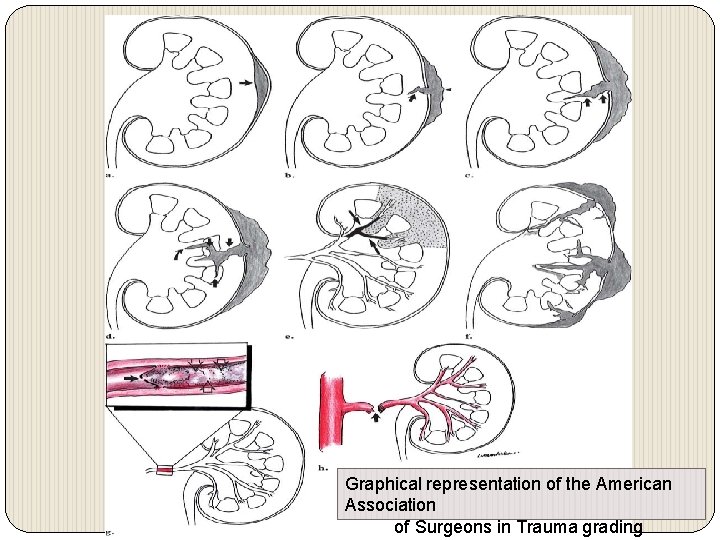 Graphical representation of the American Association of Surgeons in Trauma grading 